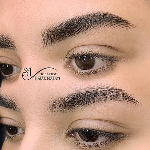 میکروپیگمنتیشن - کد ۱۰۵