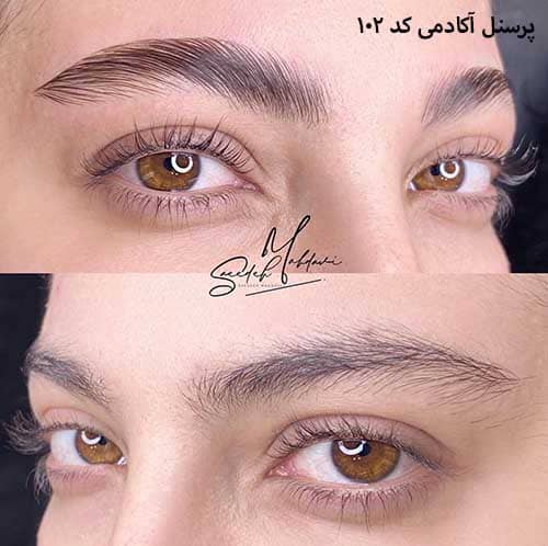 لیفت ابرو ۱۰۲