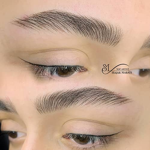 میکروپیگمنتیشن - کد ۱۰۵